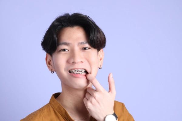 Niềng răng bao nhiêu tiền? Chi phí chỉnh nha phụ thuộc vào những yếu tố nào?