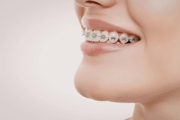 Niềng răng bao lâu? Quy trình chỉnh nha chi tiết từ A-Z