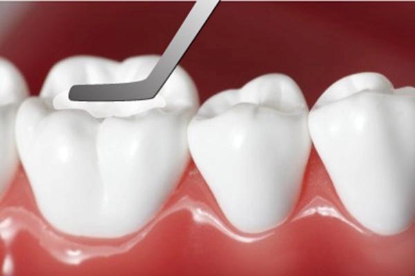Trám răng là gì? Khi nào cần trám và quy trình thực hiện ra sao?