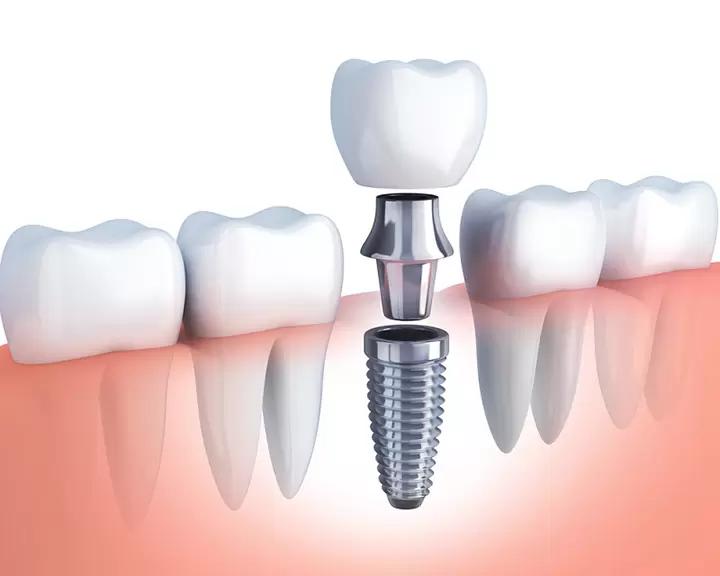 Trồng răng Implant - Bảo vệ sức khỏe lâu dài