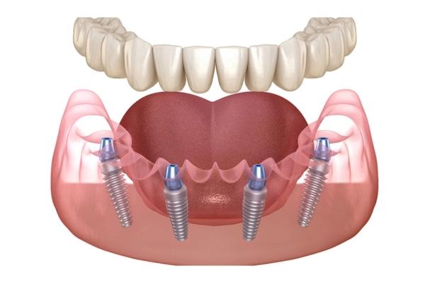 Trồng răng Implant toàn hàm - giải pháp cho người mất răng toàn bộ