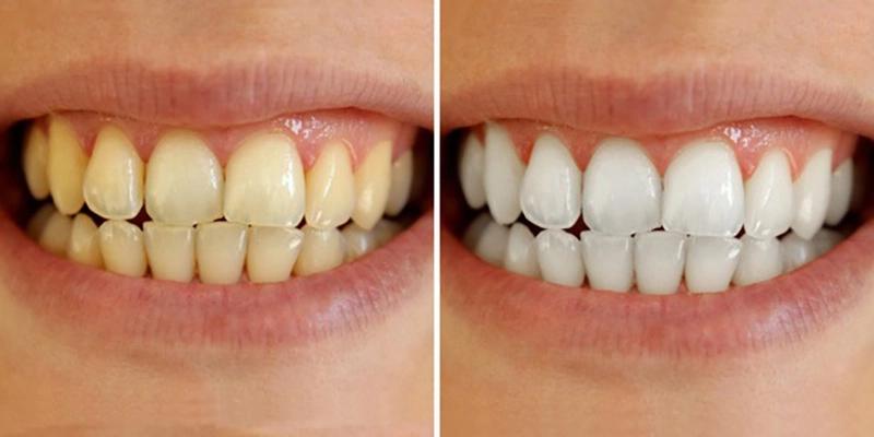 Tẩy trắng răng - Bí quyết cho nụ cười tự tin, trắng sáng