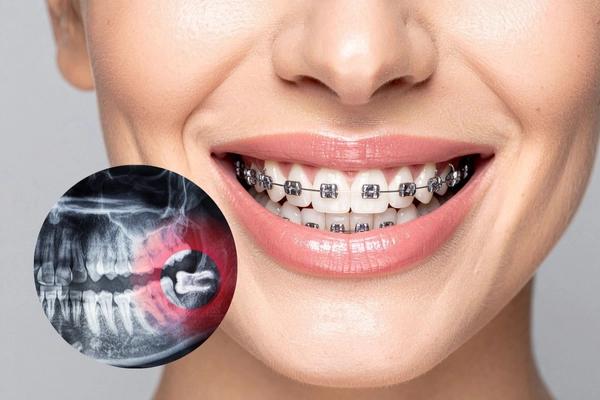 Vì sao cần nhổ răng khôn trước khi niềng răng